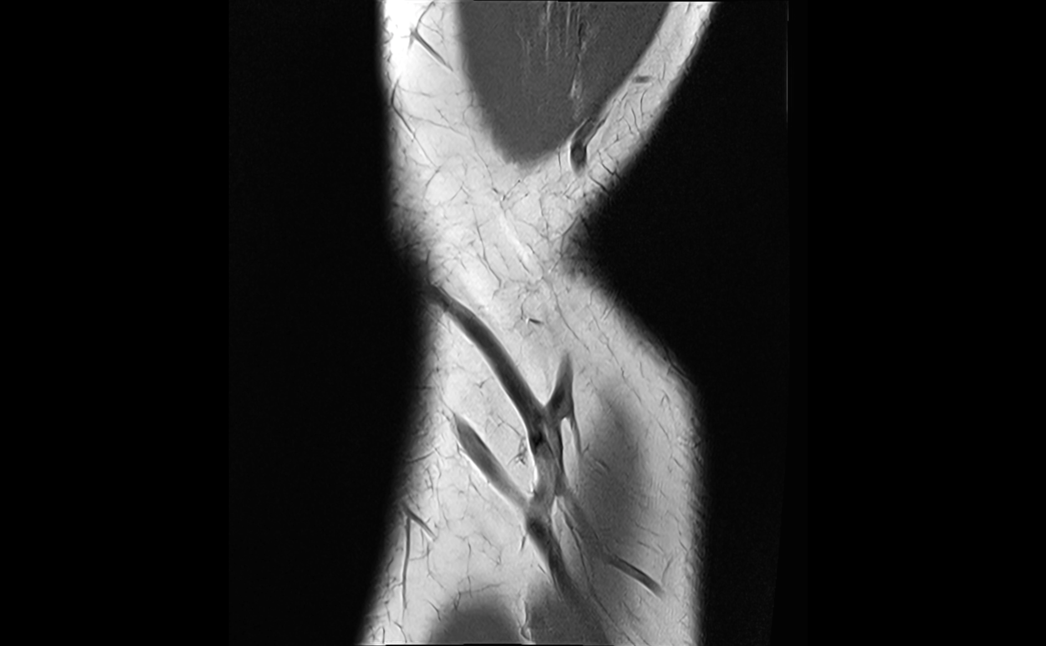 MRI elbow ligaments coronal cross sectional anatomy 3T  radiology  image-img-07001-00004.webp